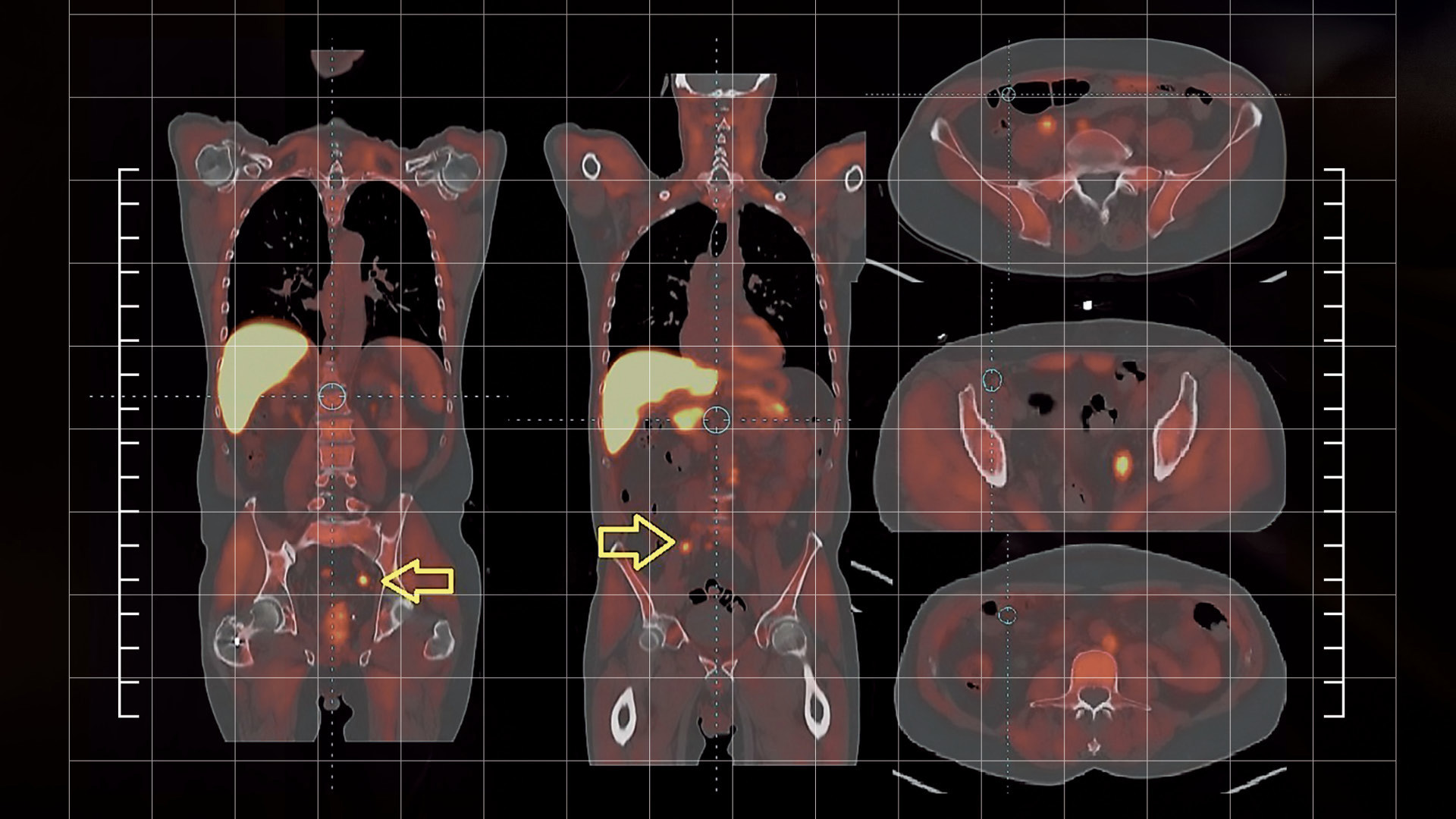 Advancing Prostate Cancer Management